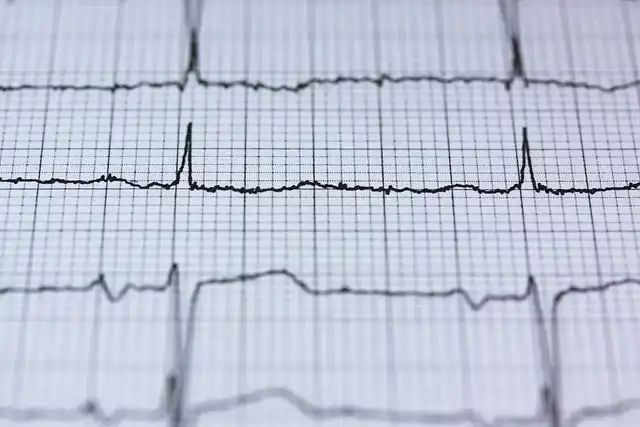 ECG tests may someday be used by AI model to detect premature aging and cognitive decline