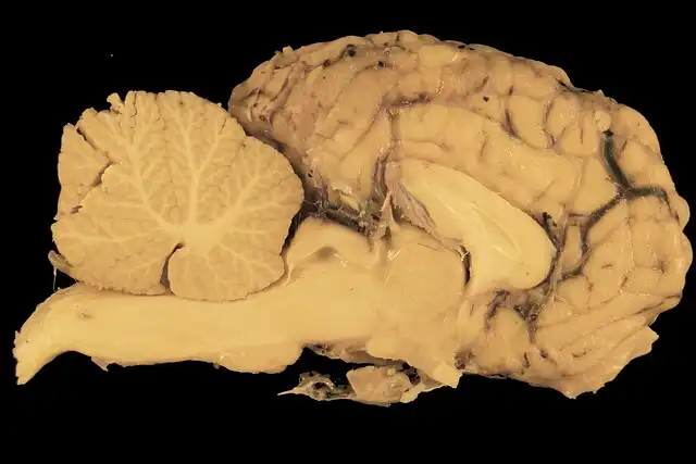 PTSD Breakthrough: New Drug Targets Brain Mechanism