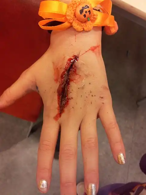 Skin in a Syringe: Hydrogel for Wound Healing & 3D-Printed Skin